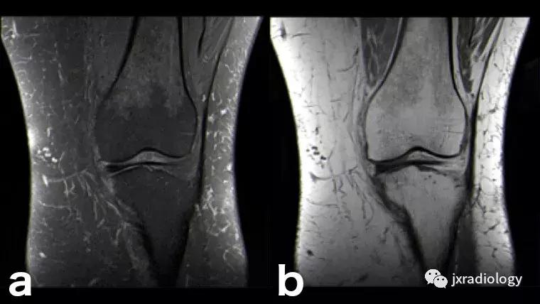 磁共振天天诊断骨髓水肿，但您知道原因吗？