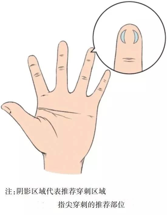 末梢采血如何出更多血,中国末梢采血操作共识解读