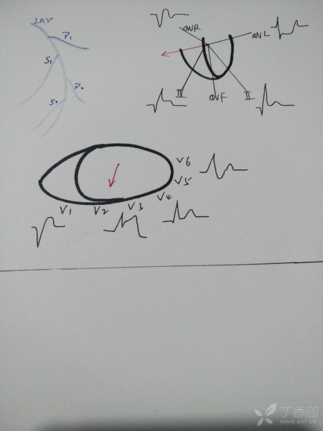 心电图心肌缺血冠脉造影正常,心脏彩超心电图冠脉造影正常