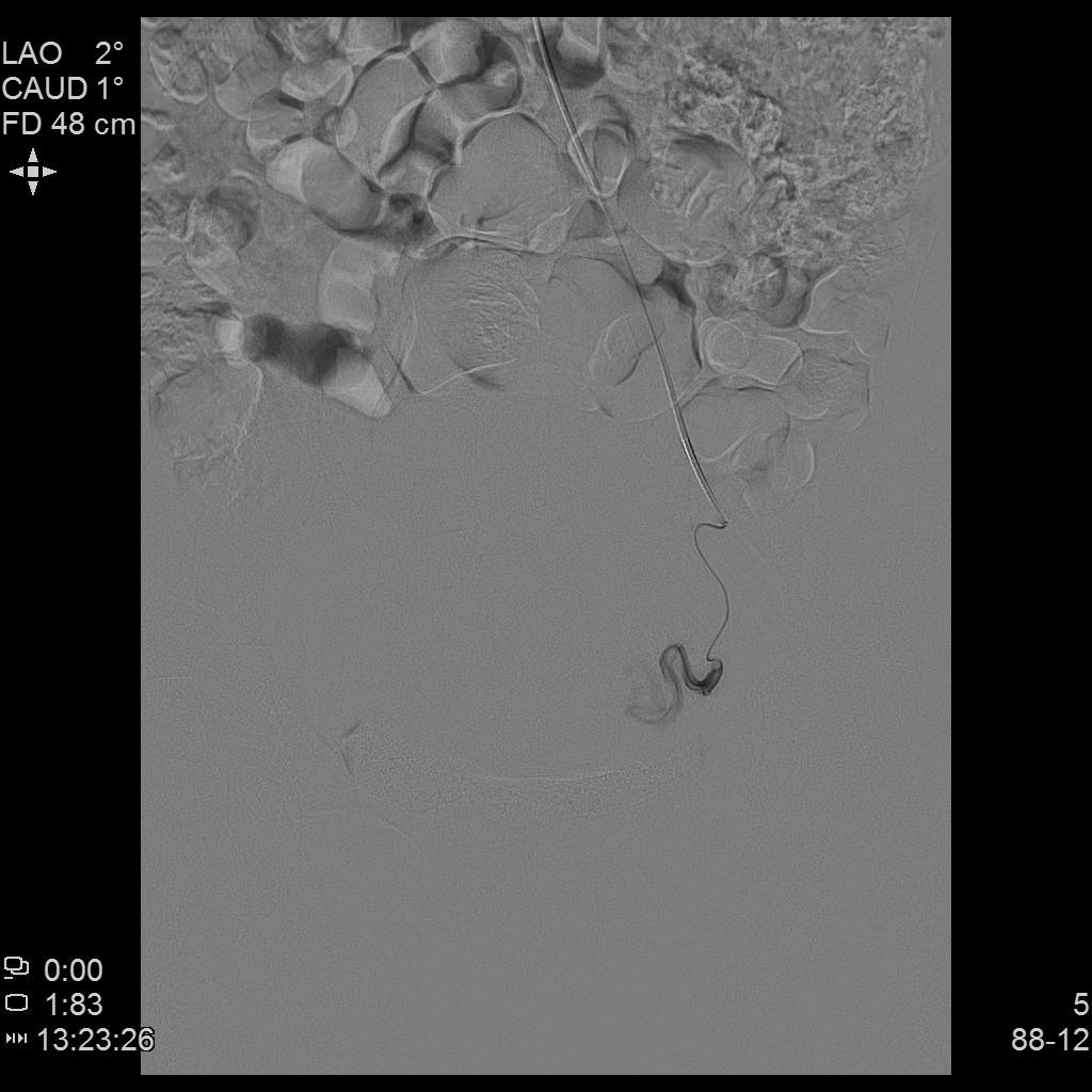 子宫腺肌症介入栓塞全国哪里好,子宫腺肌症介入栓塞治疗报销吗