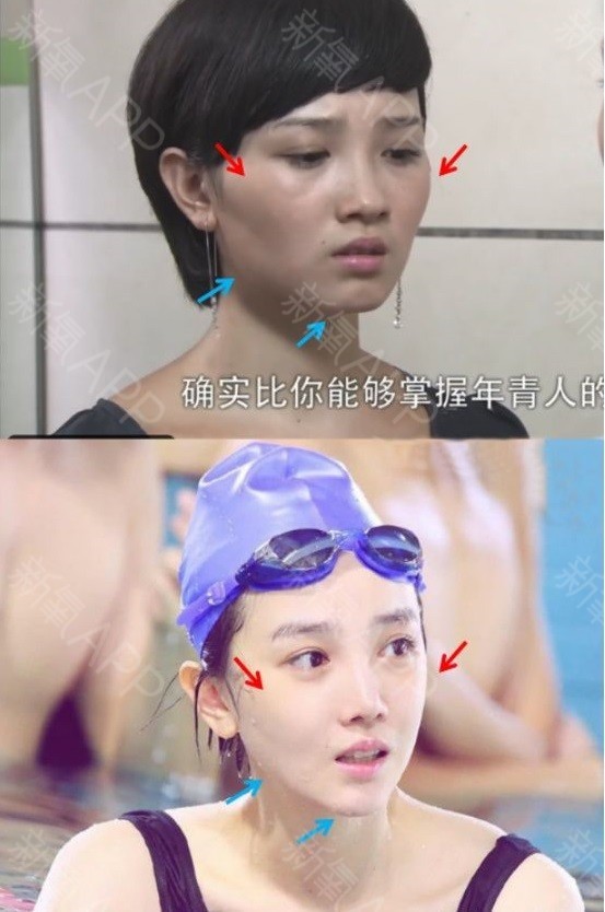 哪个明星做了颧骨内推,颧骨内推明星前后对比