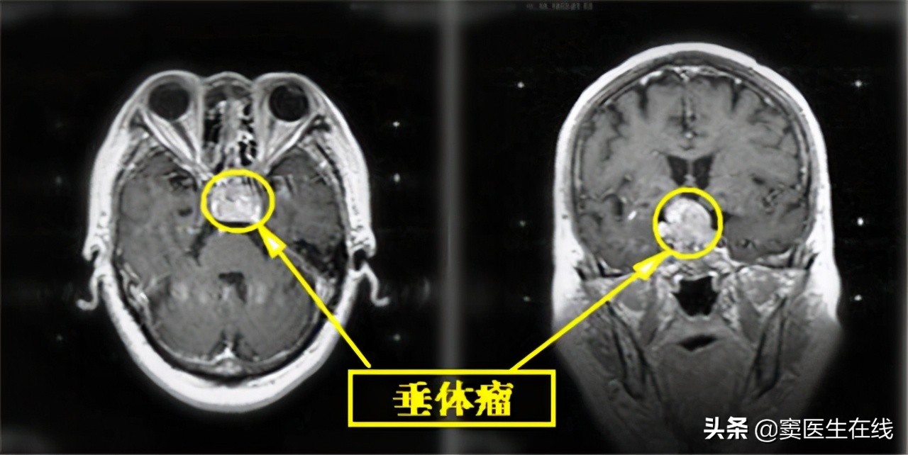 甲磺酸溴隐亭有什么用处,甲磺酸溴隐亭片对胎儿有影响吗