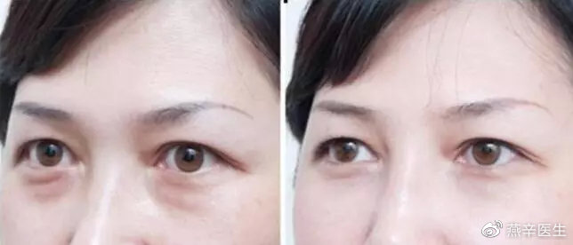 科普篇眼部整形的七大误区,关于眼整形这些事你一定要知道