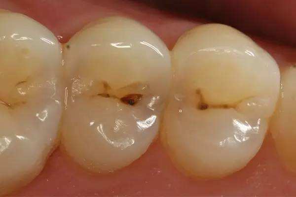 严重的蛀牙怎么修复,轻微的蛀牙修复全过程