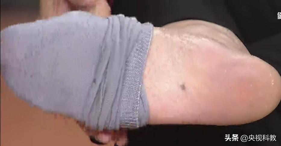 身上的黑痣有癌变的风险吗,身上长黑痣怎样防止恶变