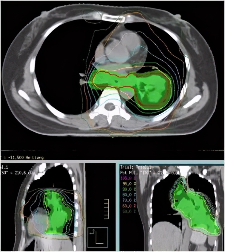 免疫疗法治鳞癌是可单独实施吗,肺转移性鳞癌免疫组化