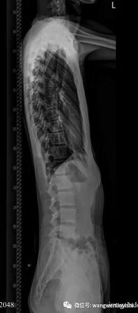 扁平型胸部,扁平胸部