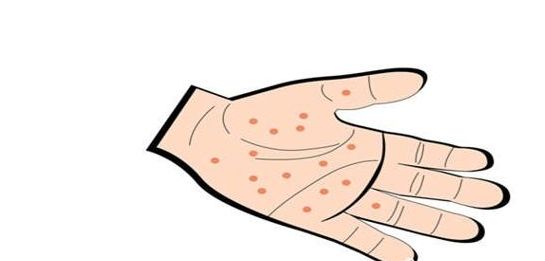 奇痒有水泡,奇痒无比的红疙瘩中间还会长水泡