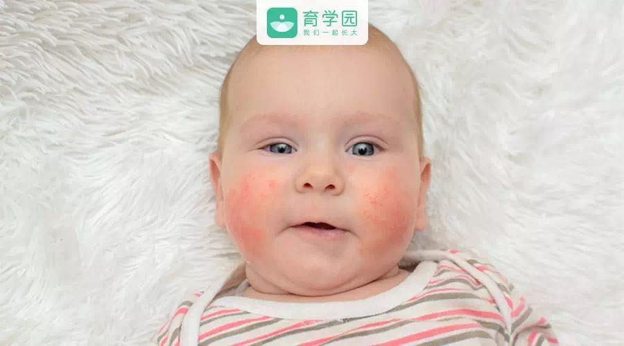 孩子反复干性湿疹,孩子得湿疹反反复复怎么办