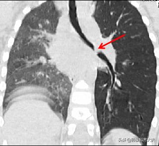 ct能查出气管微小异物嘛,气管异物ct怎么做
