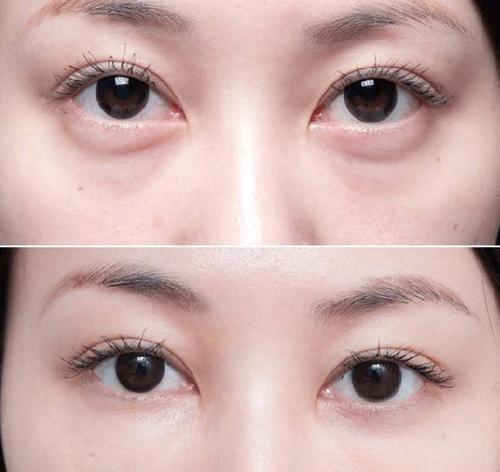 为什么睡那么早眼袋还是那么重,天天睡不好眼圈和黑眼袋特别重