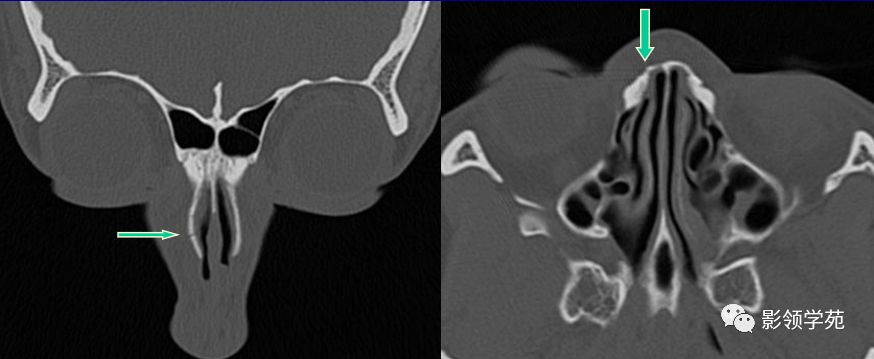 鼻骨骨折的检查方法,鼻骨骨折影像学表现