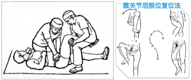 小孩髋关节脱臼复位手法视频,宝宝髋关节脱位可以正骨复位吗