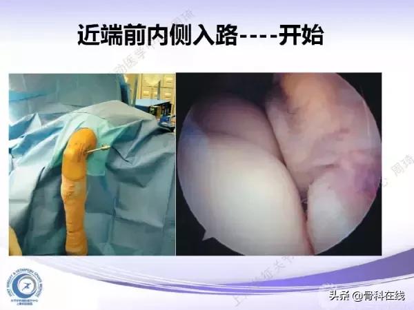 肘关节镜手术后引流,肘关节镜微创手术