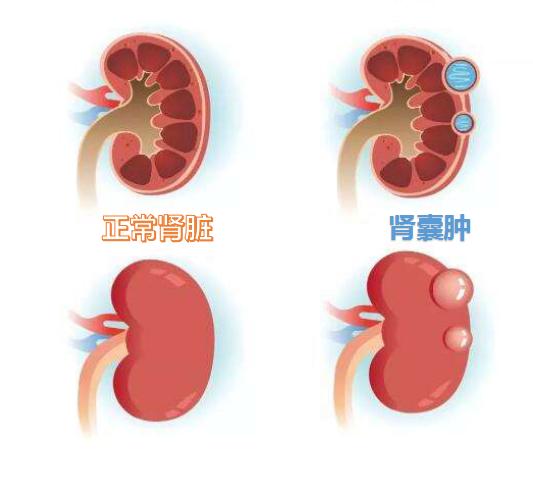 体检发现肾囊肿怎么办?医生告诉你最佳的应对方法