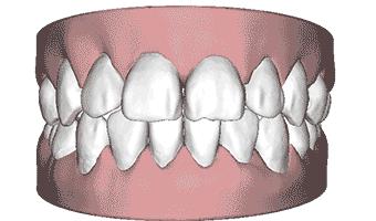牙齿矫正别轻易拔牙,牙齿矫正要先磨牙吗