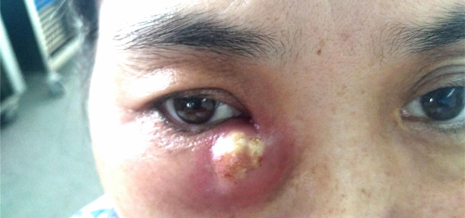 泪囊炎眼角有硬块出脓是什么原因,慢性泪囊炎急性恶化