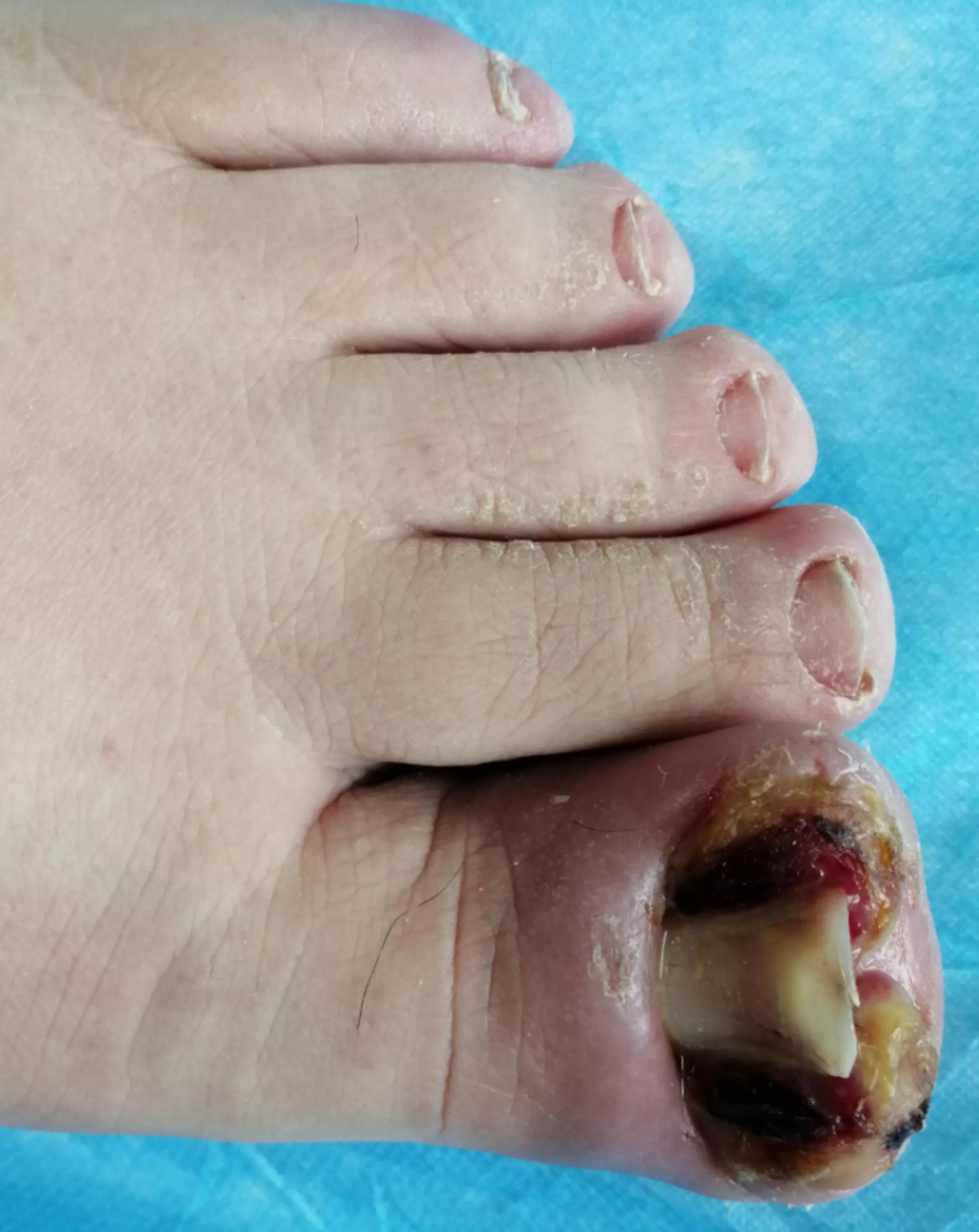 甲沟炎脚趾肿了要多久才能自愈,甲沟炎整个脚趾疼