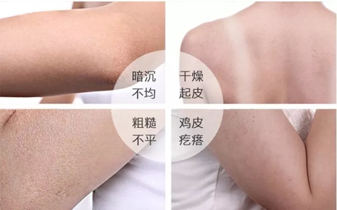身体皮肤护理去痘印,身体保湿祛鸡皮肤