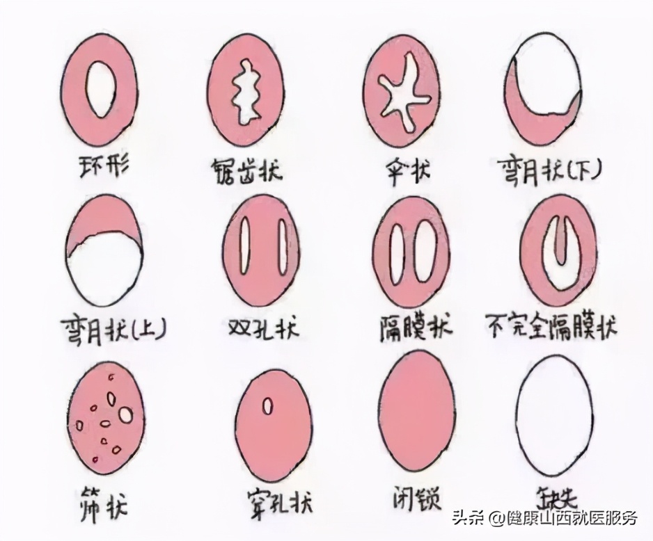 第一次*生活性**一定会流血？处女膜到底有啥作用？科普的解释来了