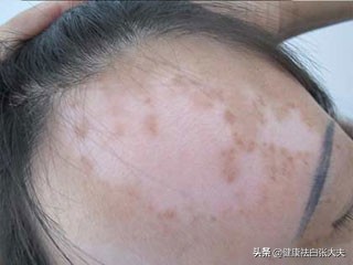 当针清碰上淋雨：陕西21岁女子为了相亲清闭口，却养出来白癜风