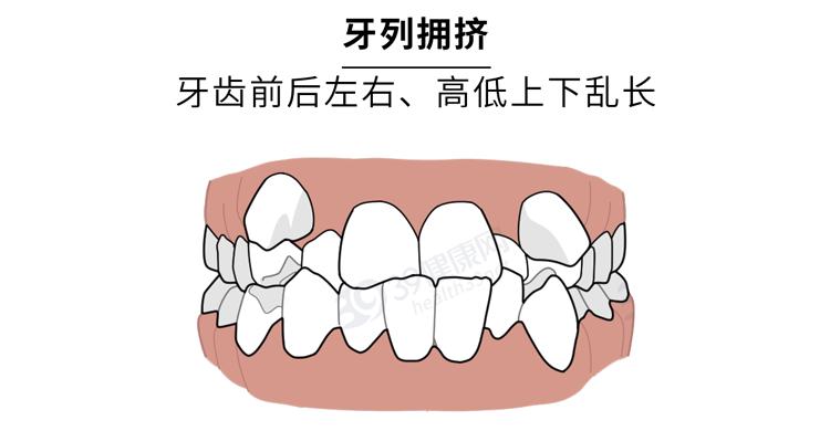 隐形牙套能矫正整齐吗,为什么戴牙套会让人变好看