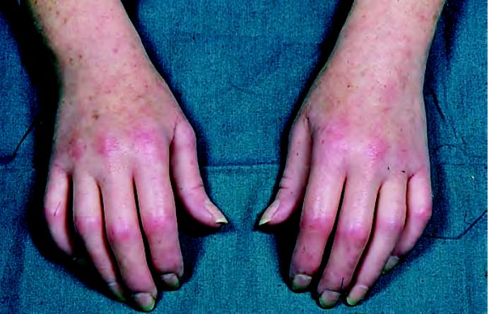 硬皮病是一种什么病,硬皮病由什么造成的