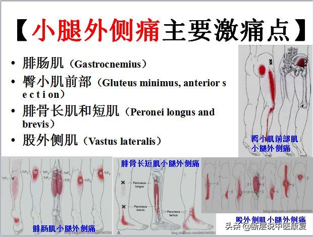 激痛点挂图,激痛点疗法笔记