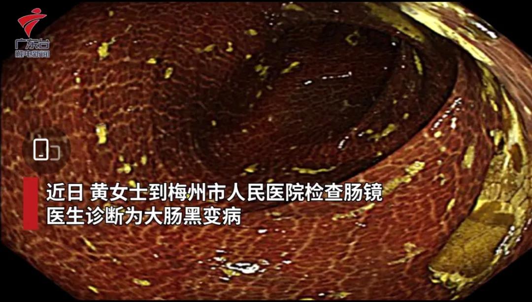 经常喝润肠通便茶肠子变成黑色,女子喝清肠茶肠子都变黑了