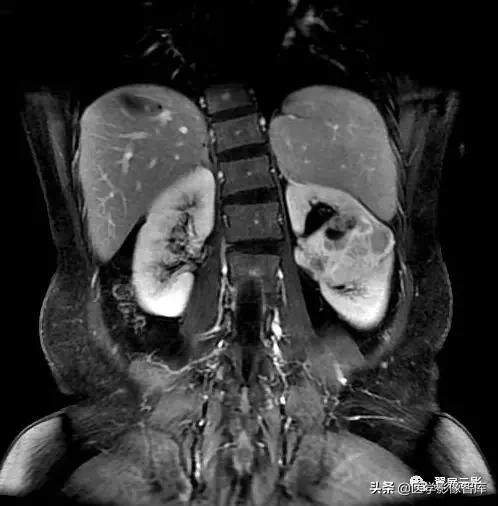 18种泌尿生殖系统常见疾病MR诊断总结