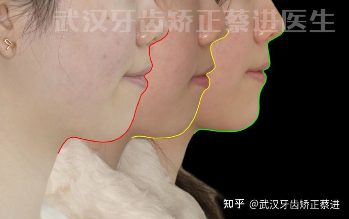 传统矫正pk隐形矫正,武汉成人正畸隐形矫正