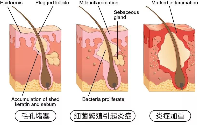 烦人的痘痘怎么来的,痘痘反复真烦人分清类型对症下药
