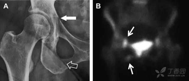 值夜班急救措施,放射科容易漏诊的骨折