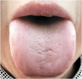 怎么靠舌头分辨肾阴虚还是阳虚,如何从舌分清阴虚阳虚