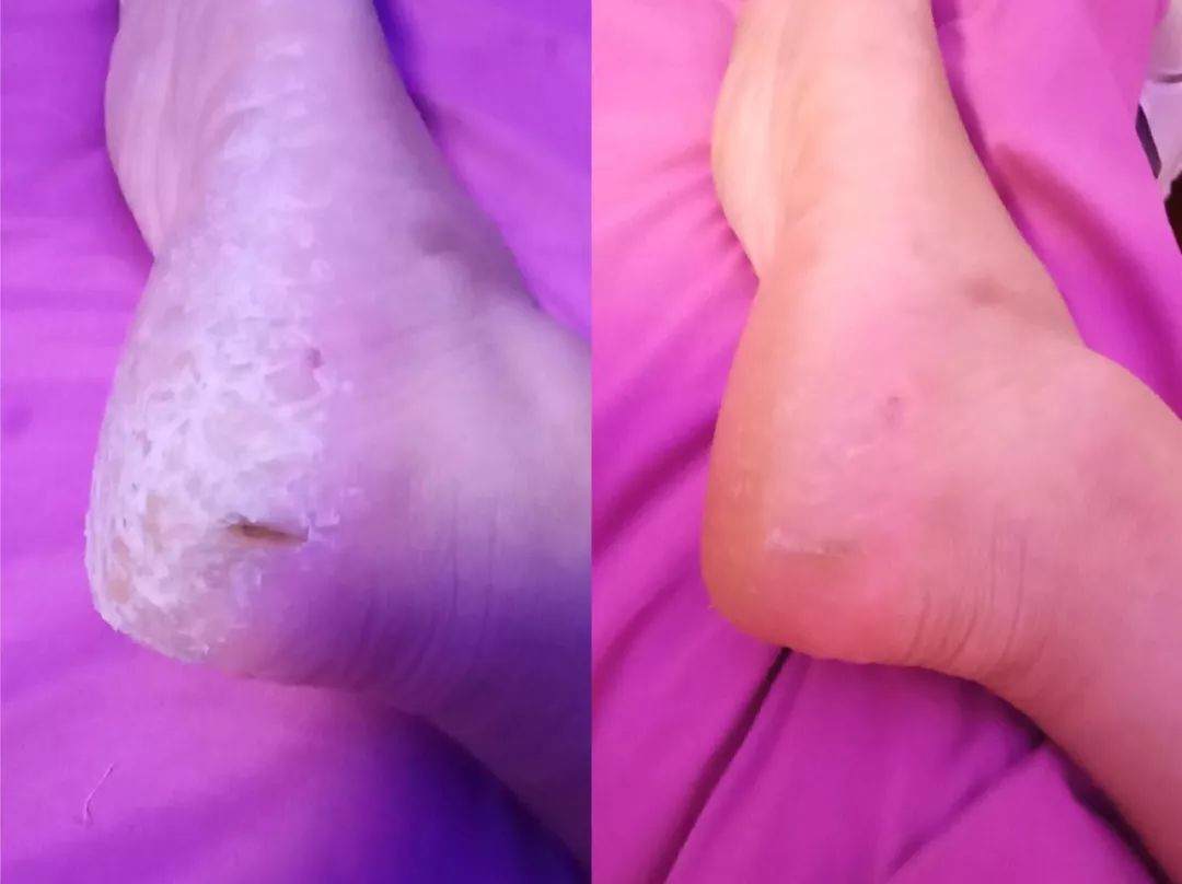 冬天脚跟干裂又起皮怎么办,冬天脚跟干裂起硬皮擦什么保湿好