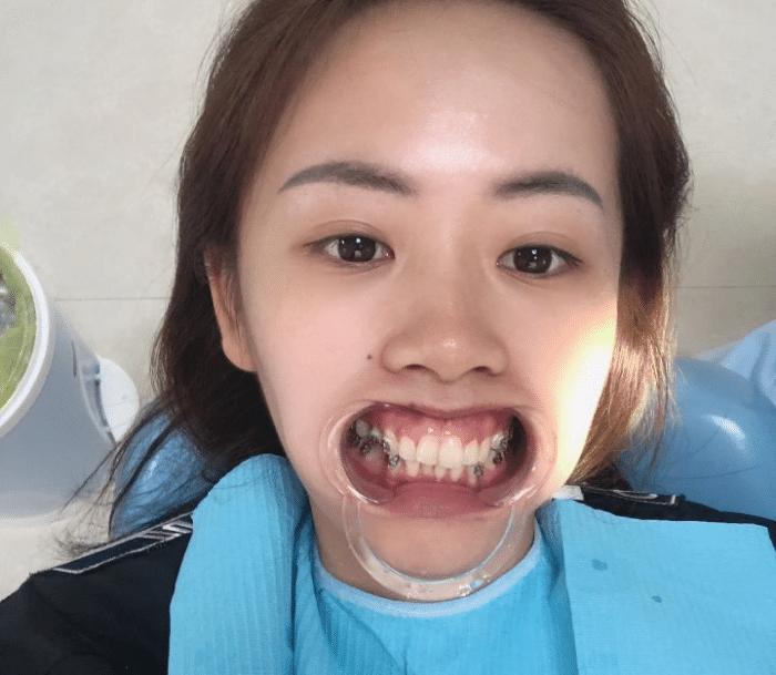 牙套隐形日记,牙套日记正颌