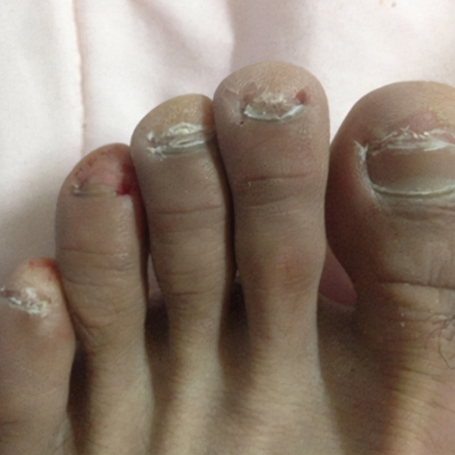 治灰指甲要验血吗,医院检查灰指甲挂号什么科