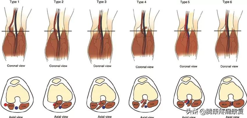 小腿疼痛的原因和治疗原则,小腿窝疼痛是什么原因造成的
