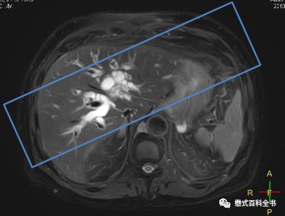 开展mrcp技术,mrcp检查操作流程