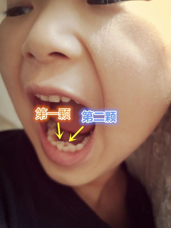 小孩口腔最里面有双排牙,孩子嘴里出了好多牙