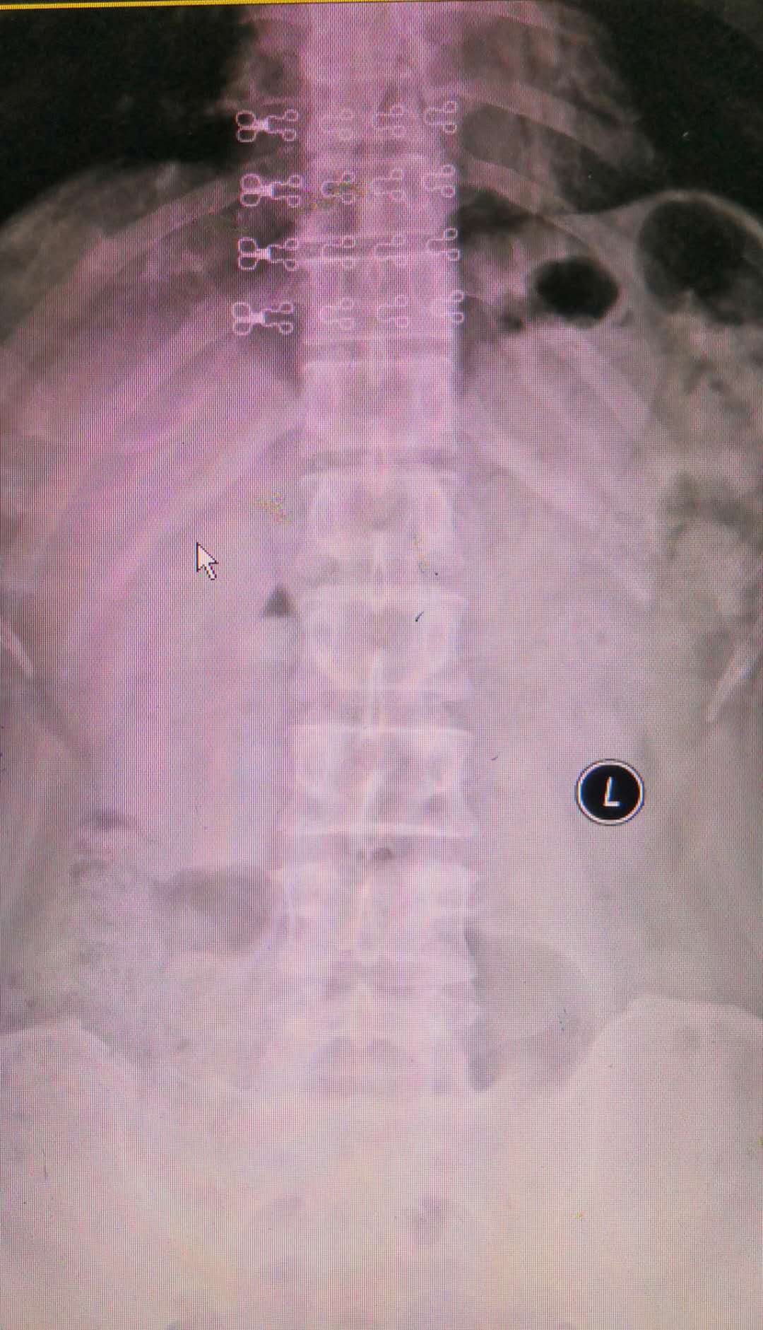 腰椎滑脱最终都要做手术么,为什么腰椎滑脱不建议手术
