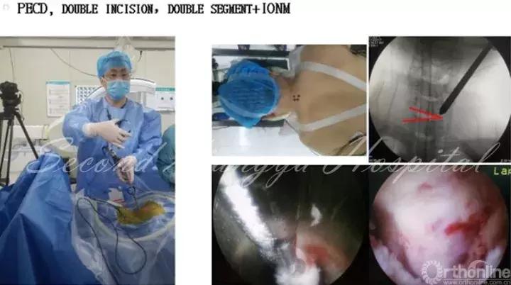 经皮腰椎间盘切除术有何优缺点,什么是经皮内镜腰椎手术