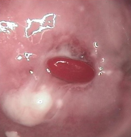 宫颈长菜花状异物是癌症吗,最近发现宫颈有硬块