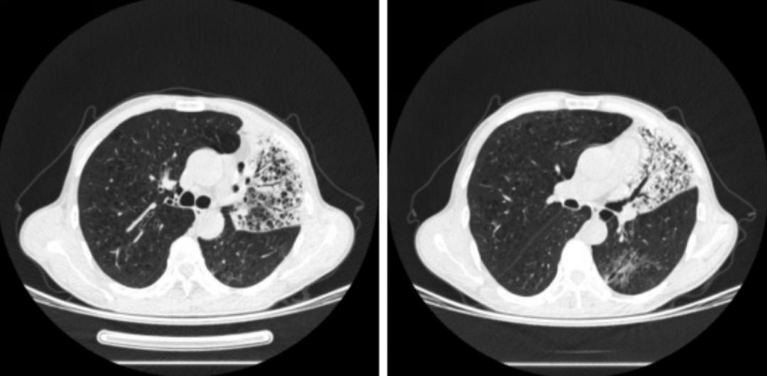 时隔一年再次住院,时隔一年旧病复发