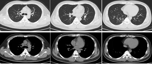 肺部陈旧病灶会变大么,肺部病灶1.2厘米严重吗