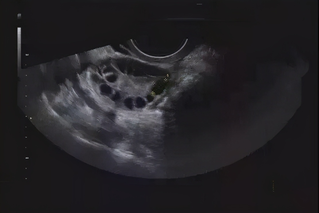 多囊卵巢综合征的四种症状,多囊卵巢综合征的10种表现