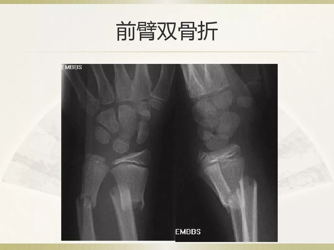 骨科x光片读片技巧,放射科骨科读片教程