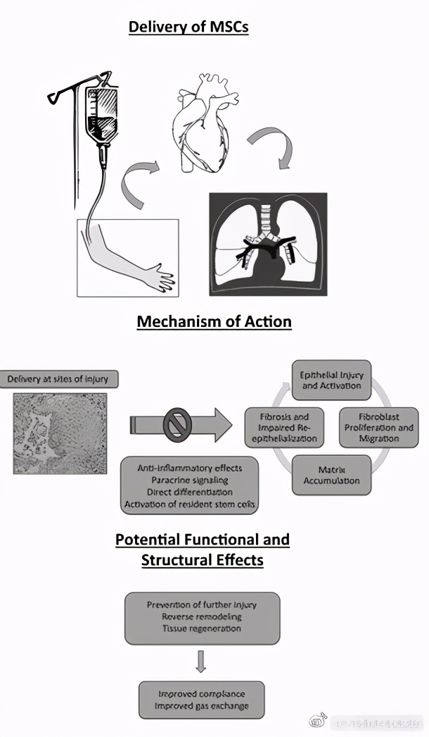 哪个医院可以用干细胞治肺纤维化,干细胞治疗特发性肺纤维化的机构
