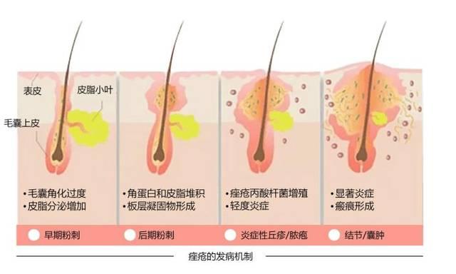 痘疮病主要危害,痤疮会自卑吗