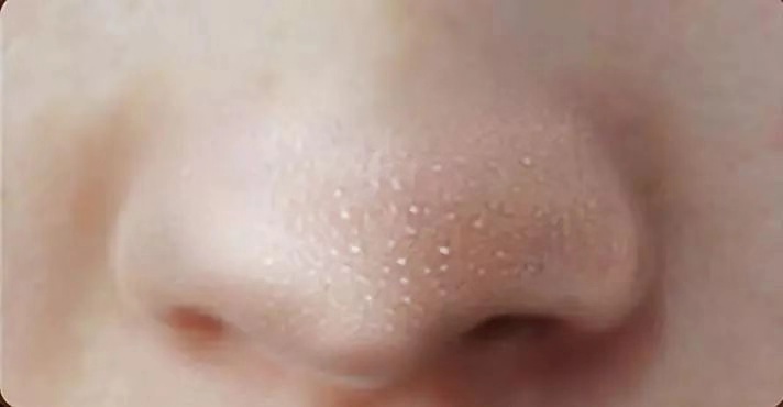 一秒去黑头去粉刺,一步就能搞定的黑头